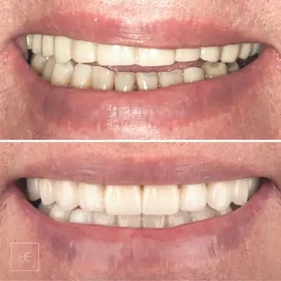 all on 4 dental implant