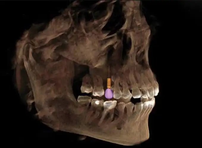 3d-xray-implantes