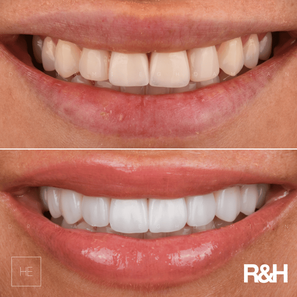 Arriana Before & After