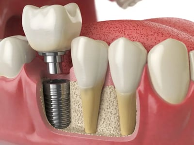 teeth implants marbella