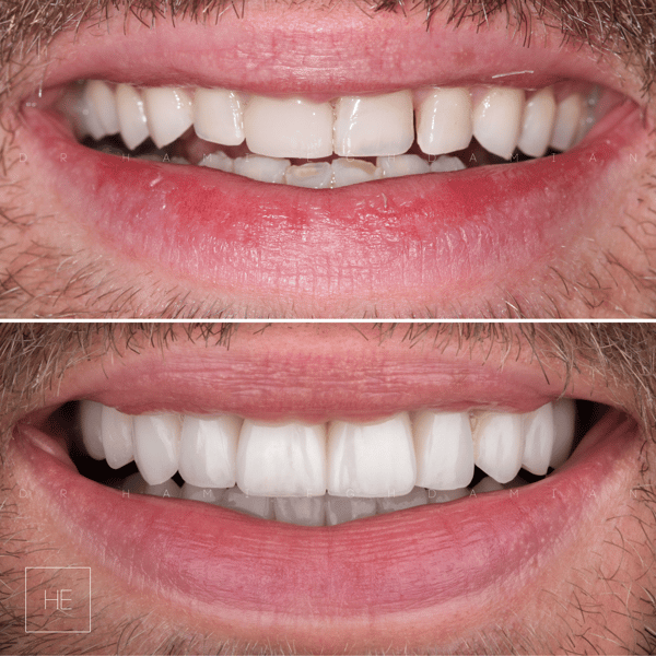 Martin Before & After