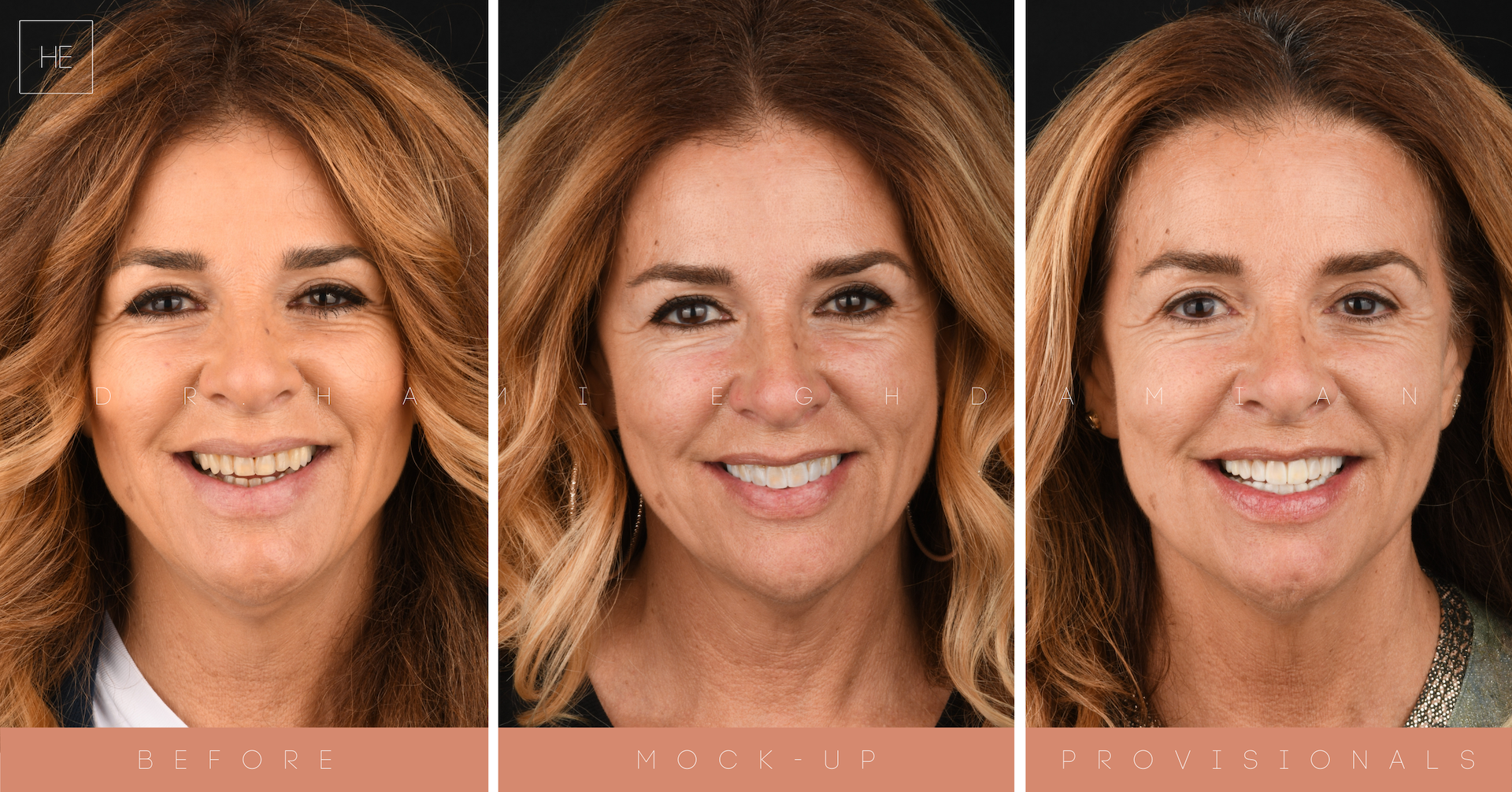 Mock-up vs. Provisionals Mock-up vs. Provisionals