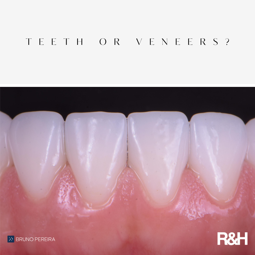 Teeth or Veneers