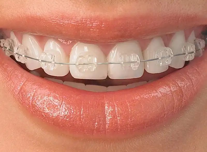 ceramic-braces