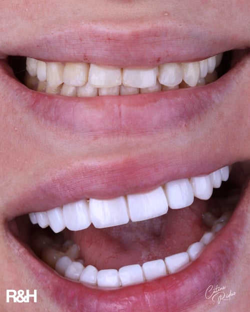 composite bonding clinic marbella