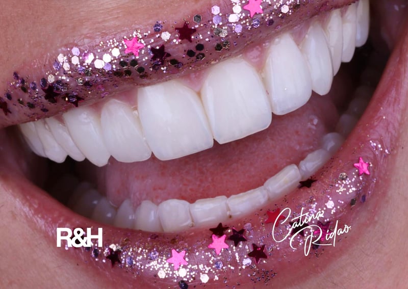 composite bonding in marbella