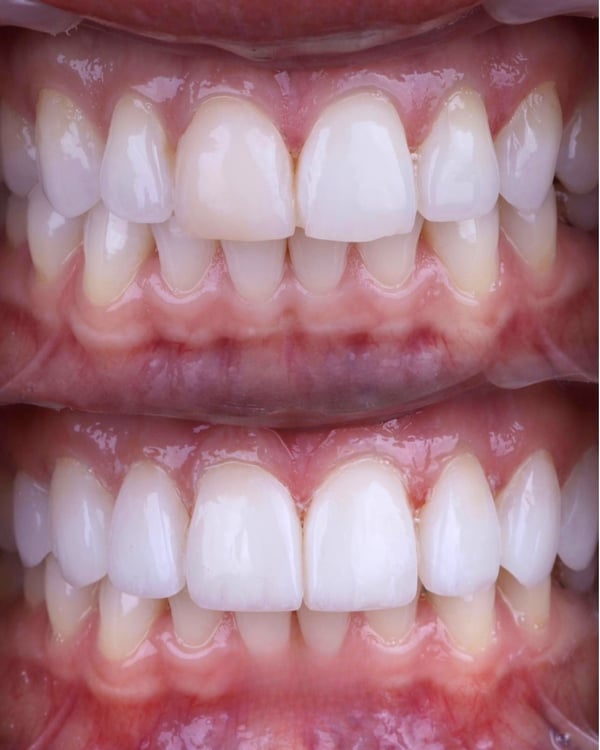 composite-bonding_before-and-after_eight-teeth composite-bonding_before-and-after_eight-teeth