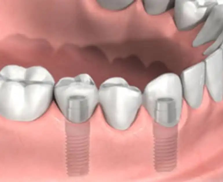 implant-supported-dental-bridge