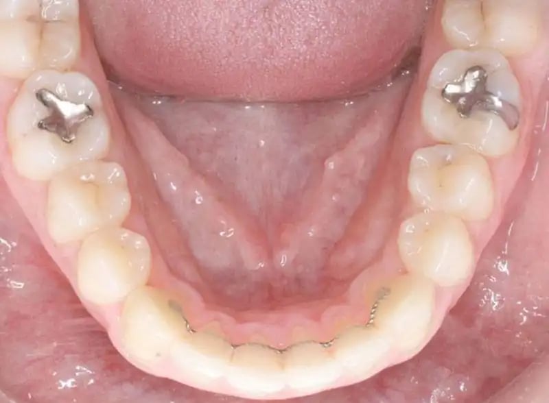lower-orthodontic-retainer