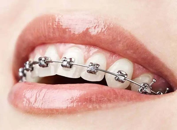 metal-braces-1