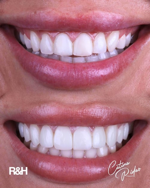 no shave composite veneers marbella