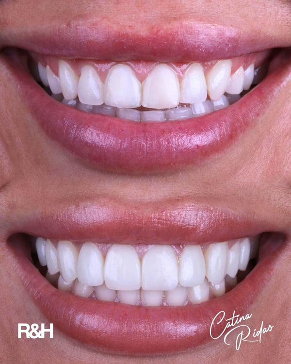no shave composite veneers marbella
