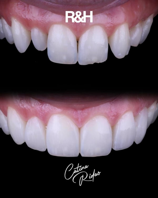 teeth bonding marbella