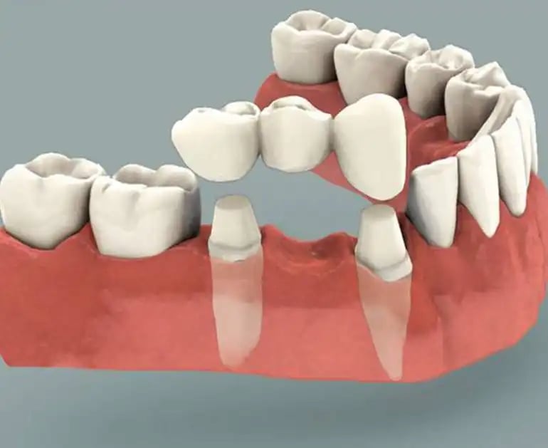tooth-supported-dental-bridge-1