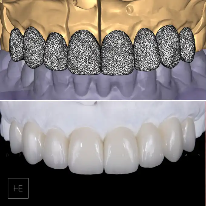 veneers marbella