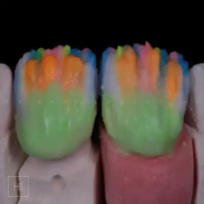 veneer smile design at dental veneers Marbella clinic