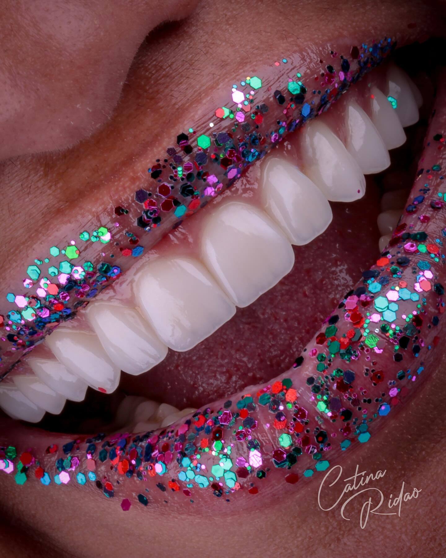 veneer dentist marbella