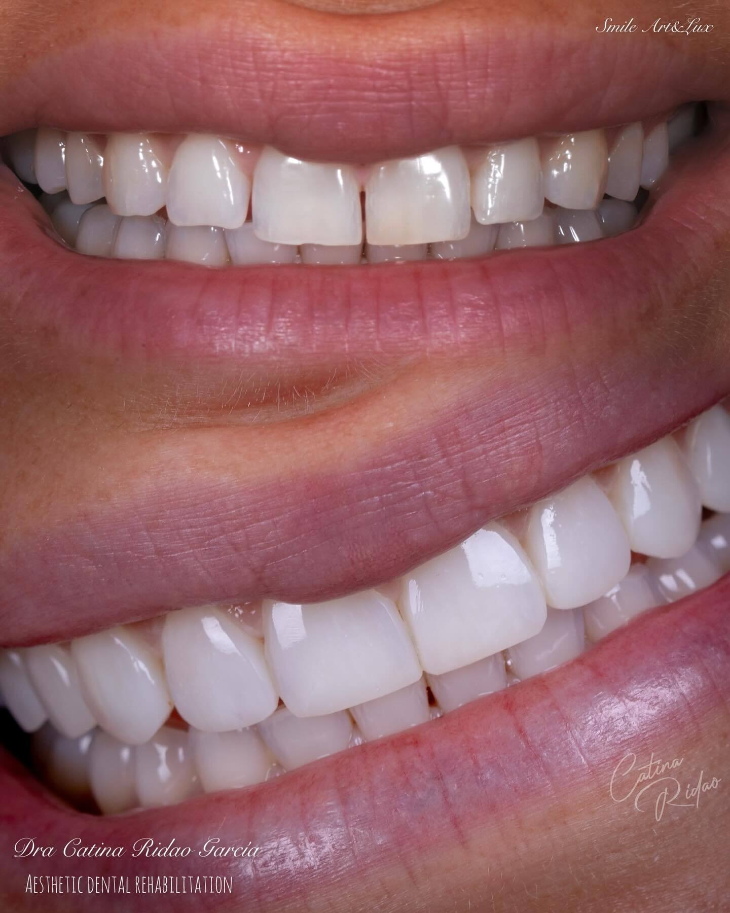 composite bonding Marbella mejora de sonrisa