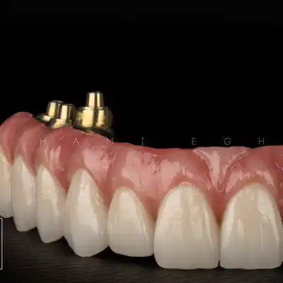 all on 6 dental implant
