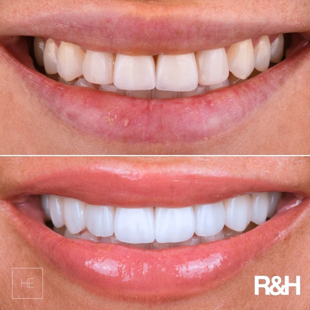 ArrianaBeforeAfter ceramic veneers in marbella
