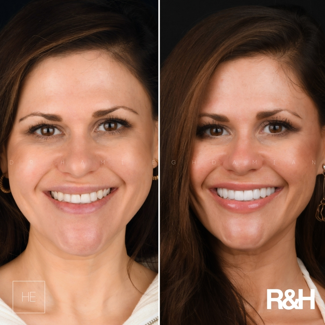 ArrianaBeforeAfterFace