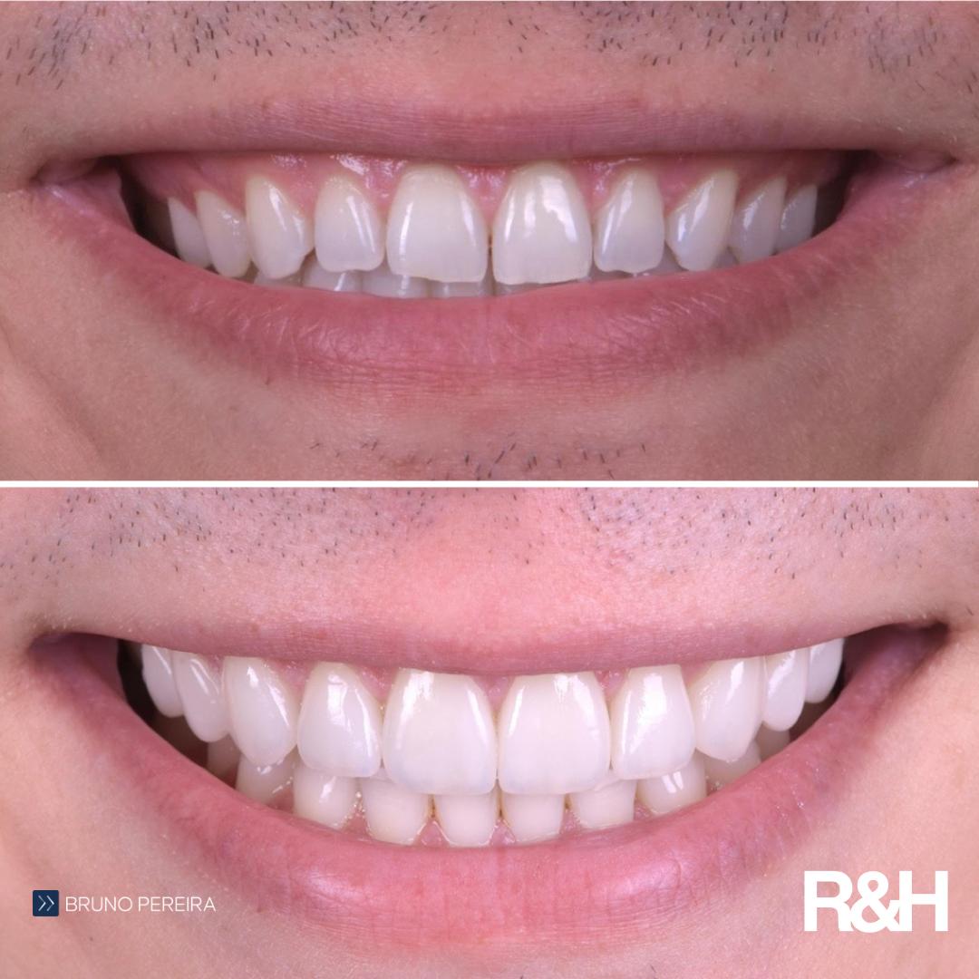 veneers that are natural in marbella