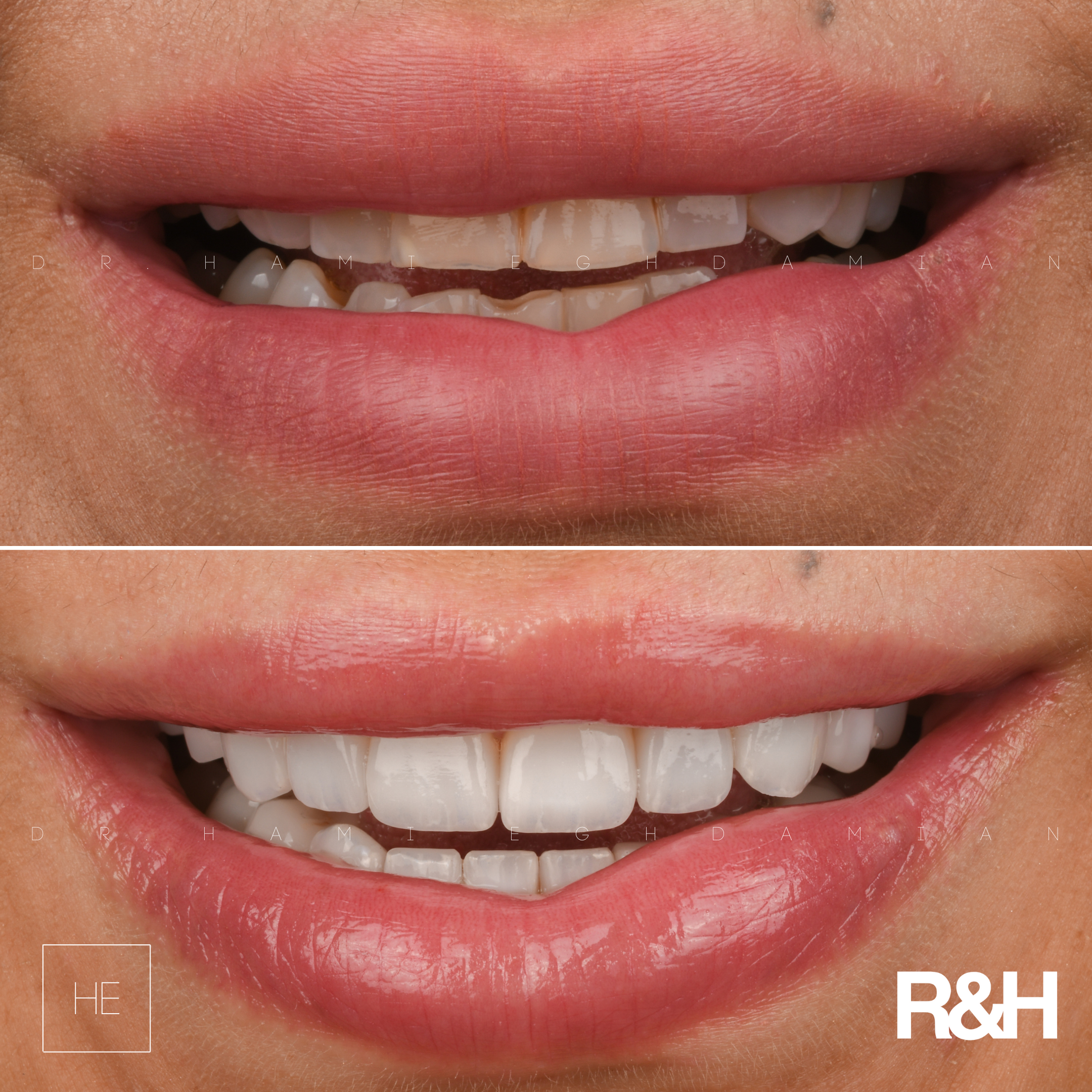 DellaBeforeAfter ceramic marbella veneers