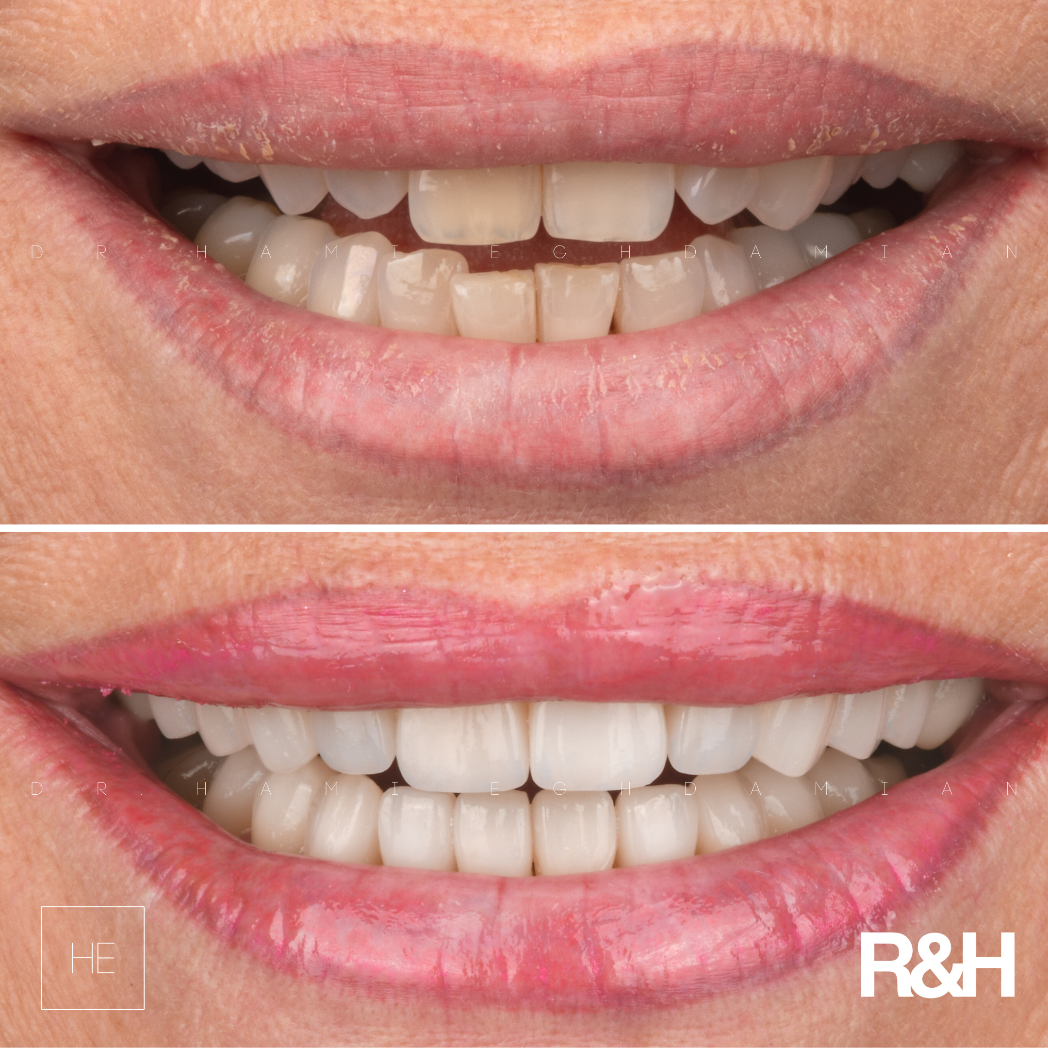 EdithBeforeAfter marbella ceramic veneers