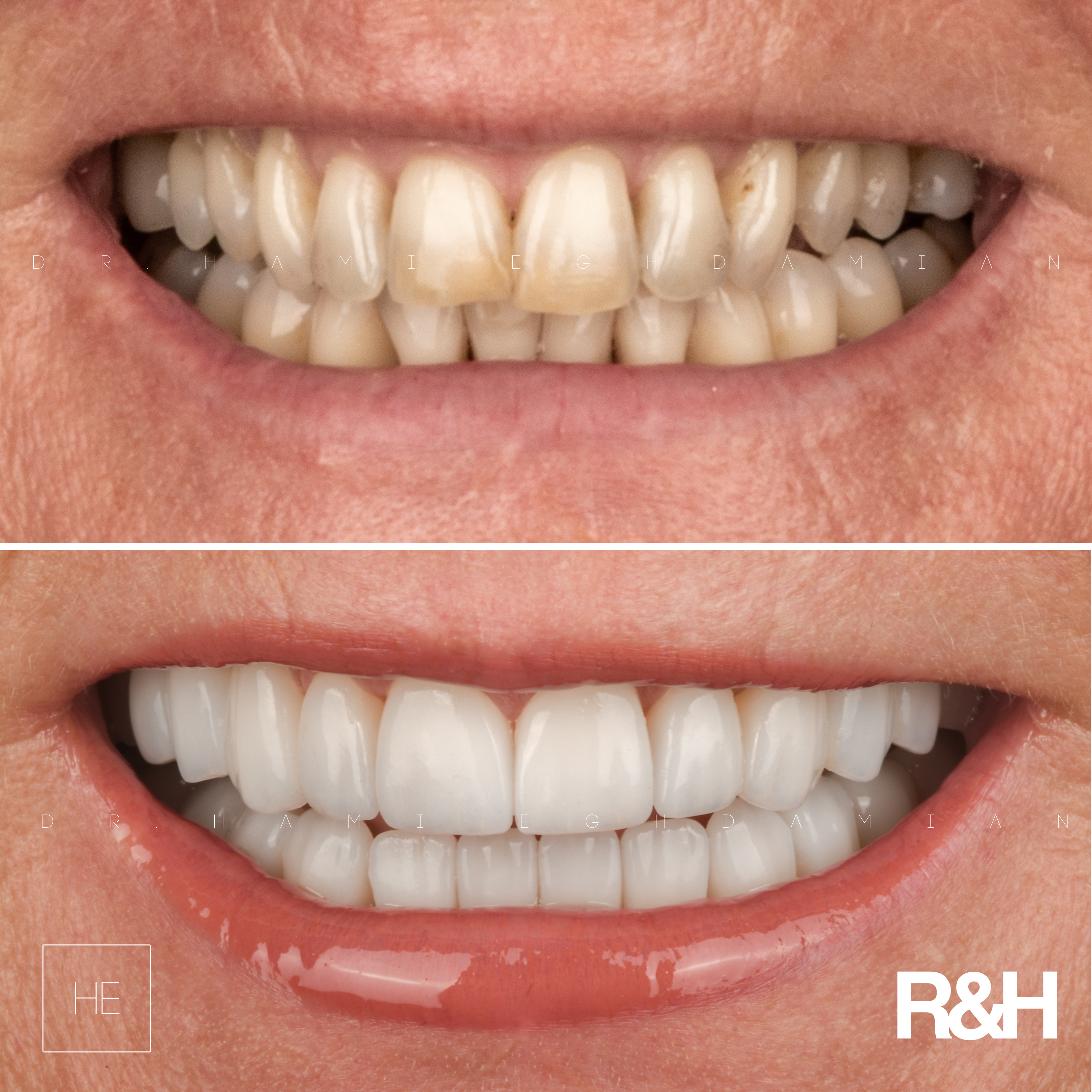 KarenBeforeAfter porcelain veneers marbella