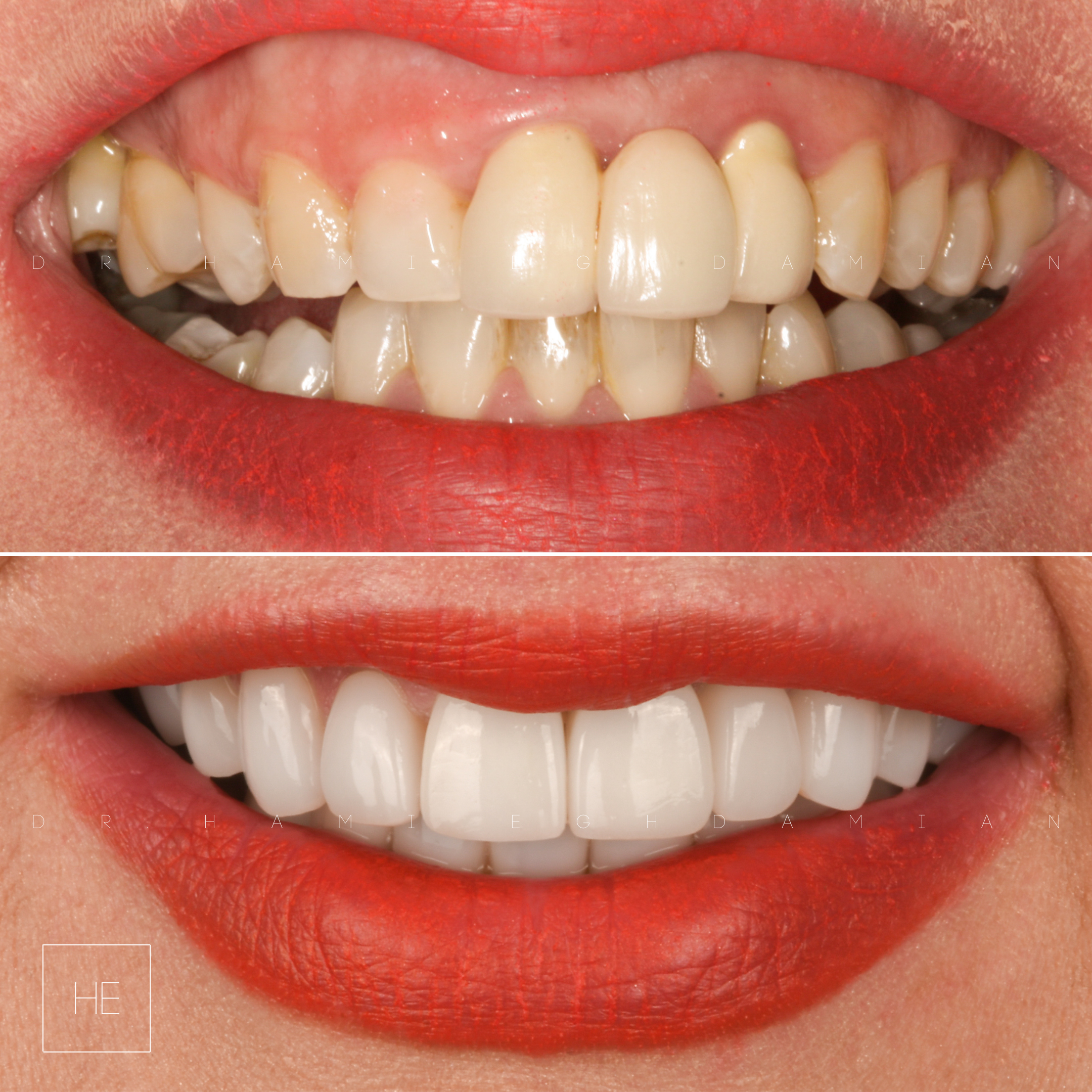LolaBeforeAfter veneers marbella