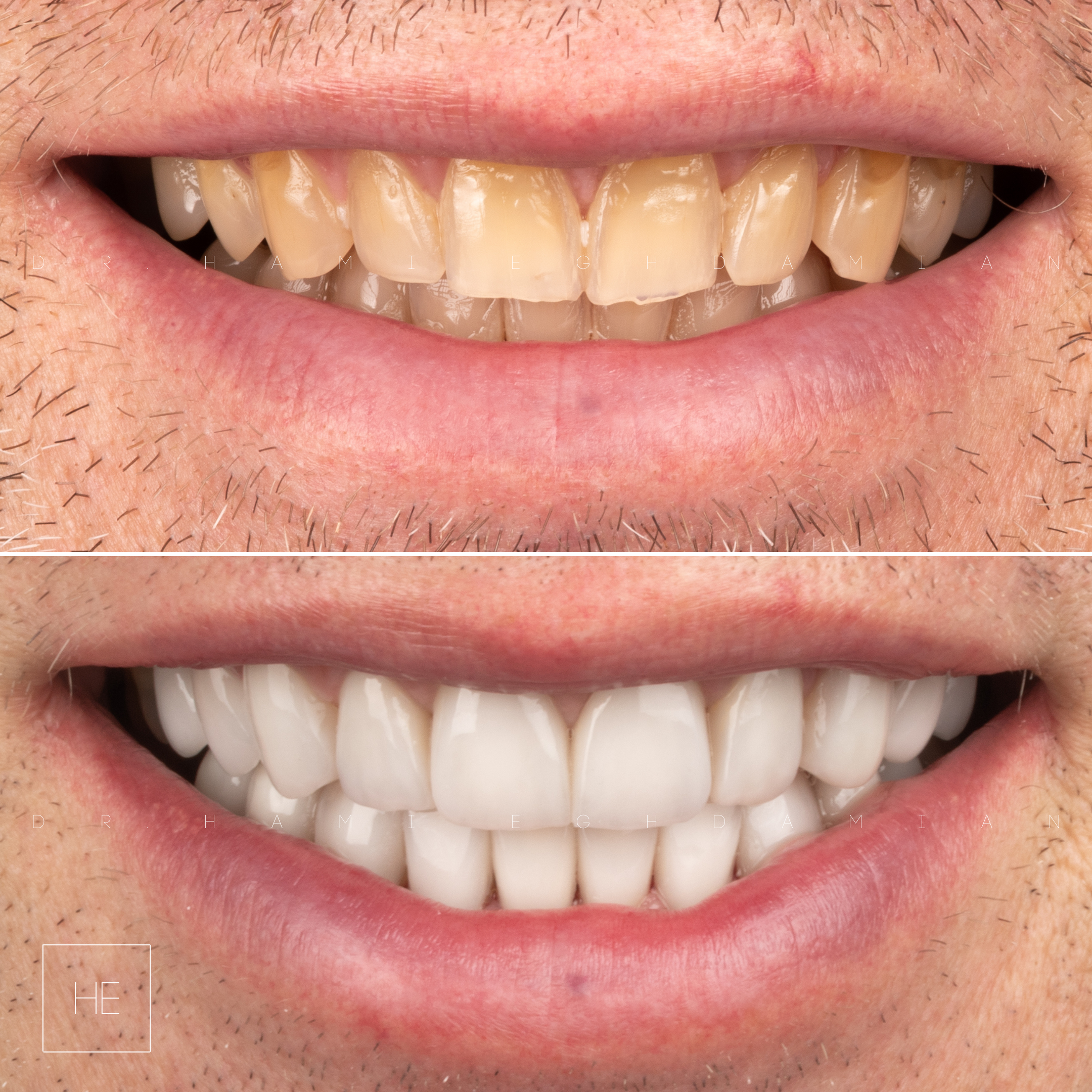 ceramic veneers marbella michael