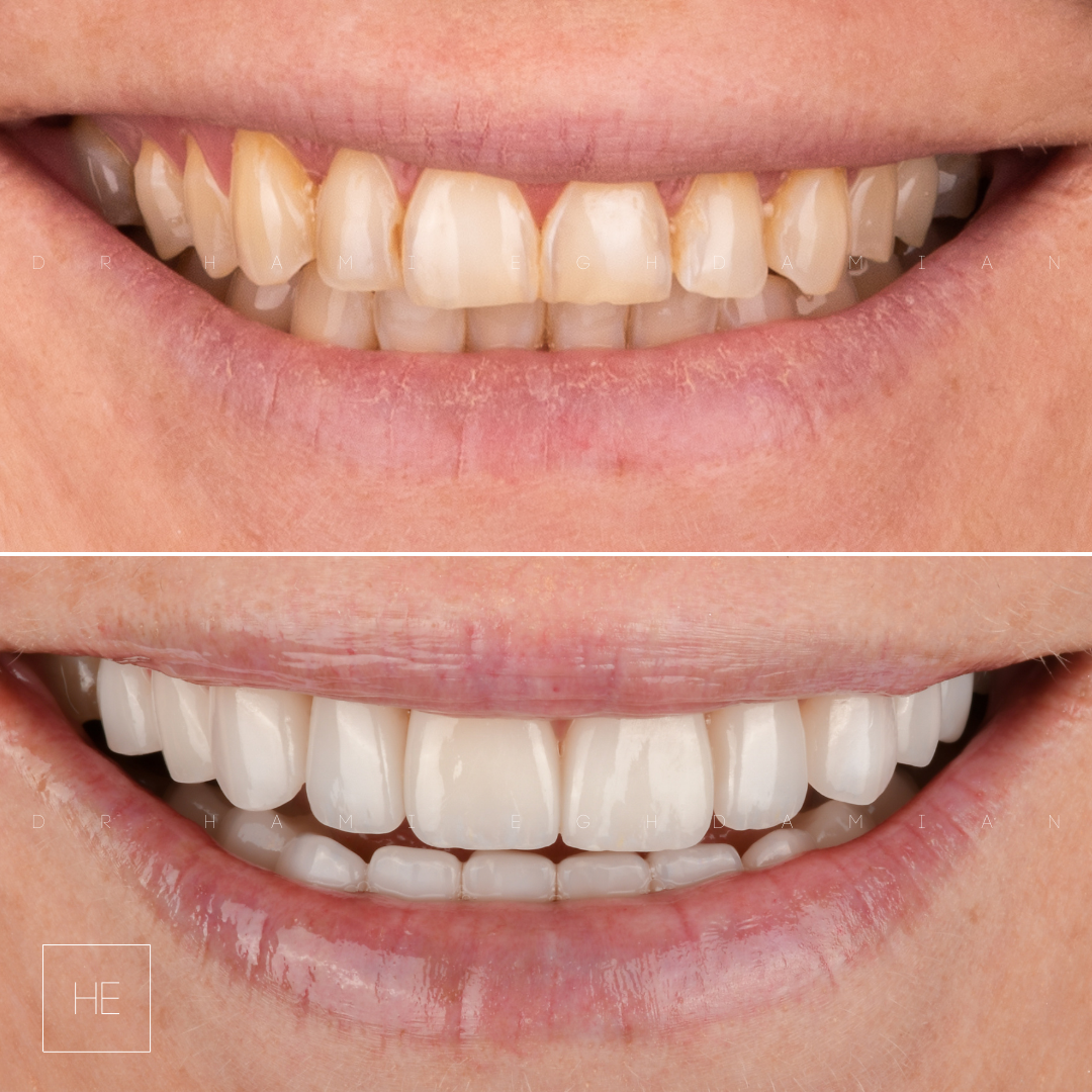 MonetBeforeAfter veneers marbella