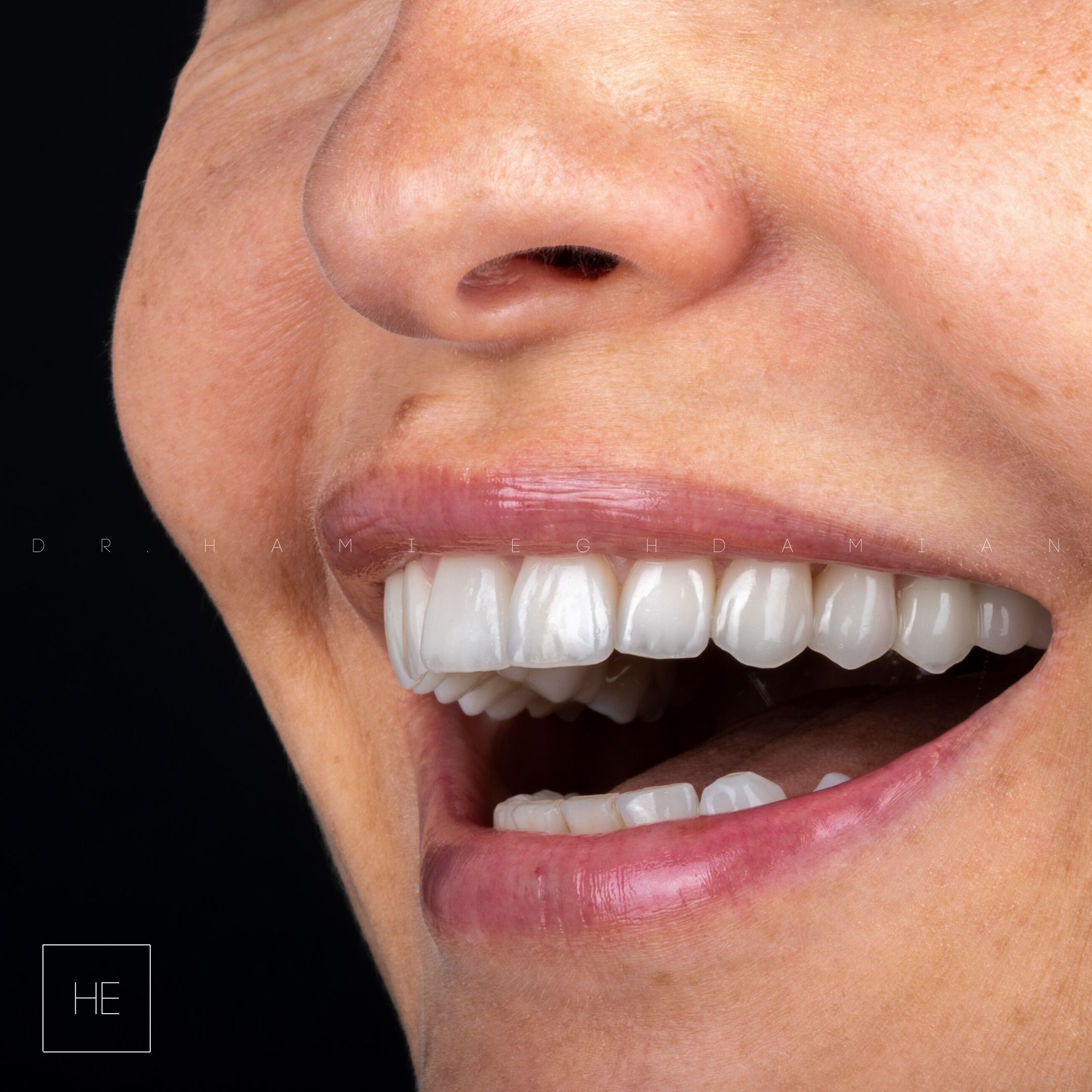 Marbella dental veneers consultation with dentist