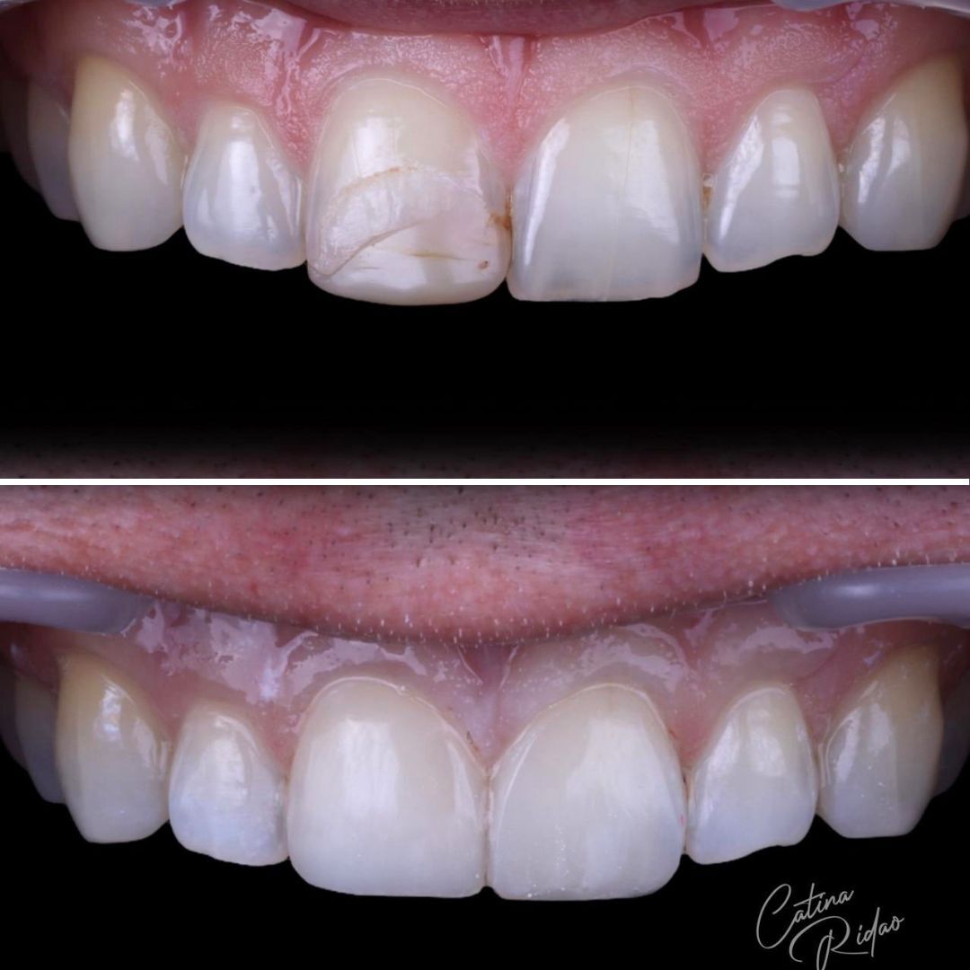 composite fillings marbella