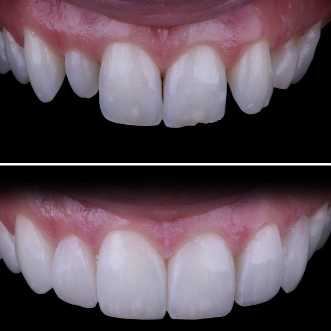 teeth bonding marbella catina