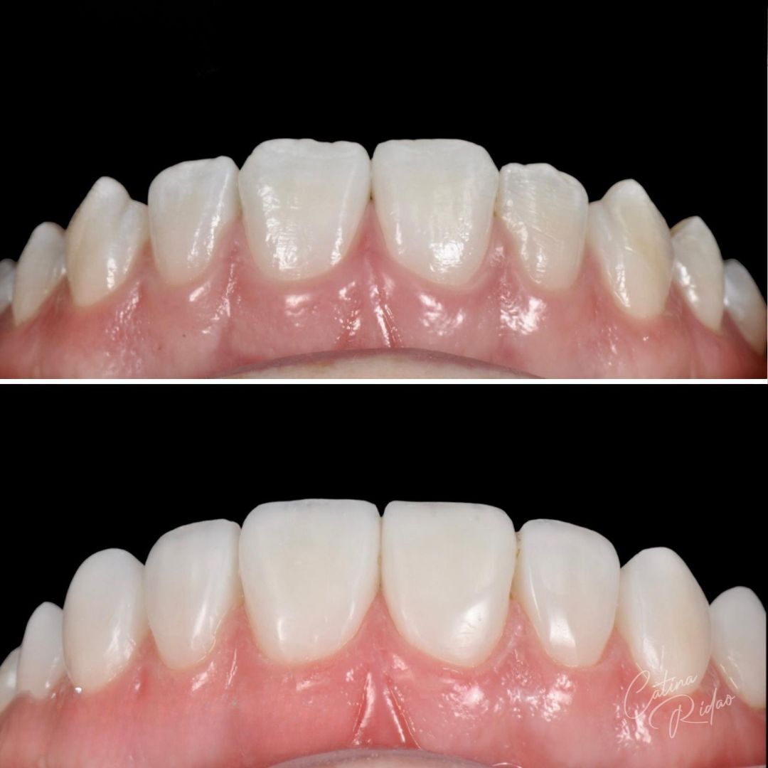 Composite veneers marbella 