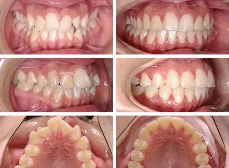 before-orthodontics-photos