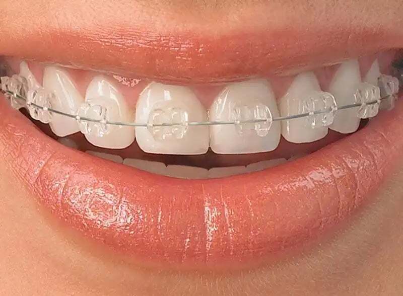 ceramic-braces-2