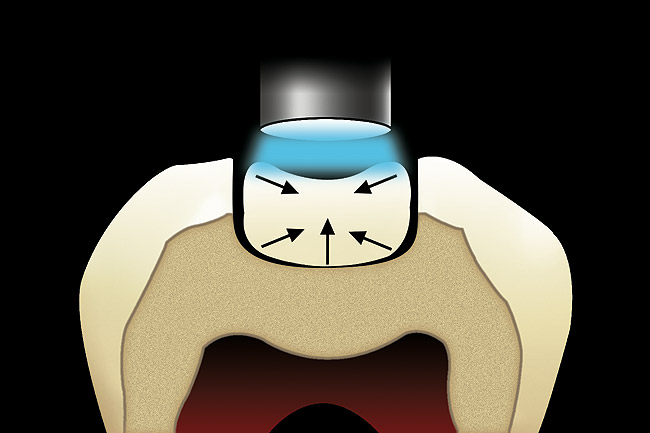 cerec inlay marbella