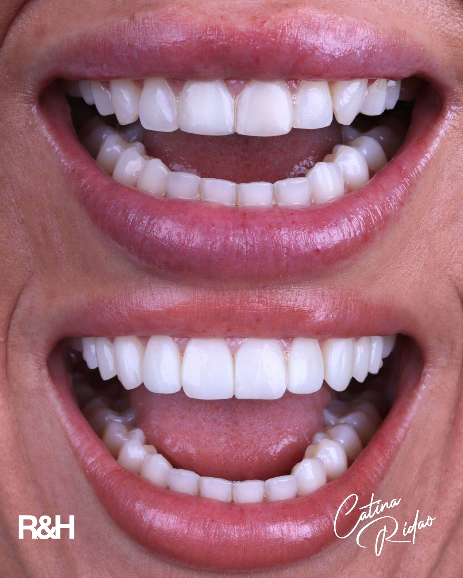 composite bonding marbella