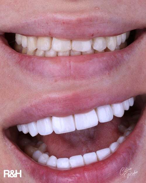 composite-bonding-clinic-marbella