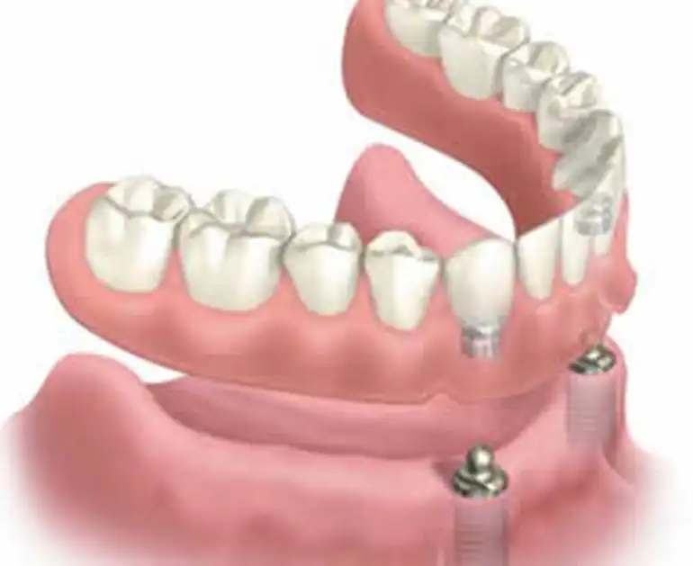lower-implant-supported-over-denture