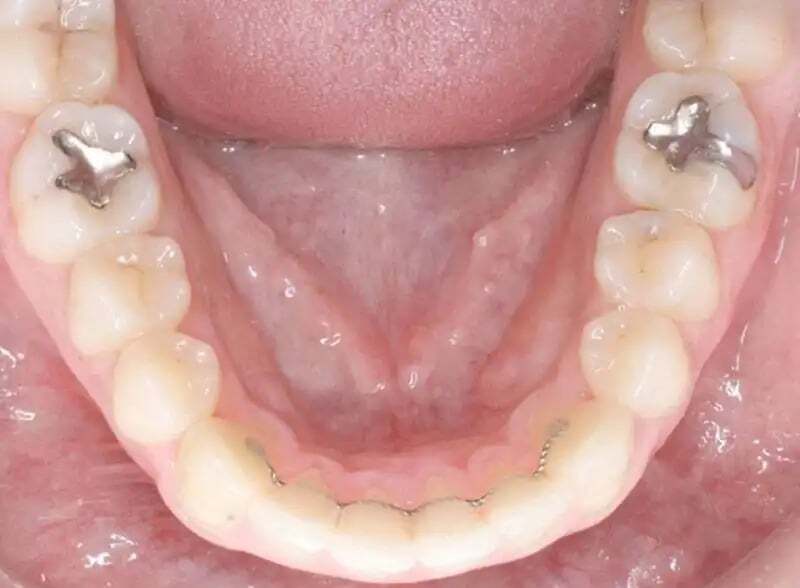lower-orthodontic-retainer-1