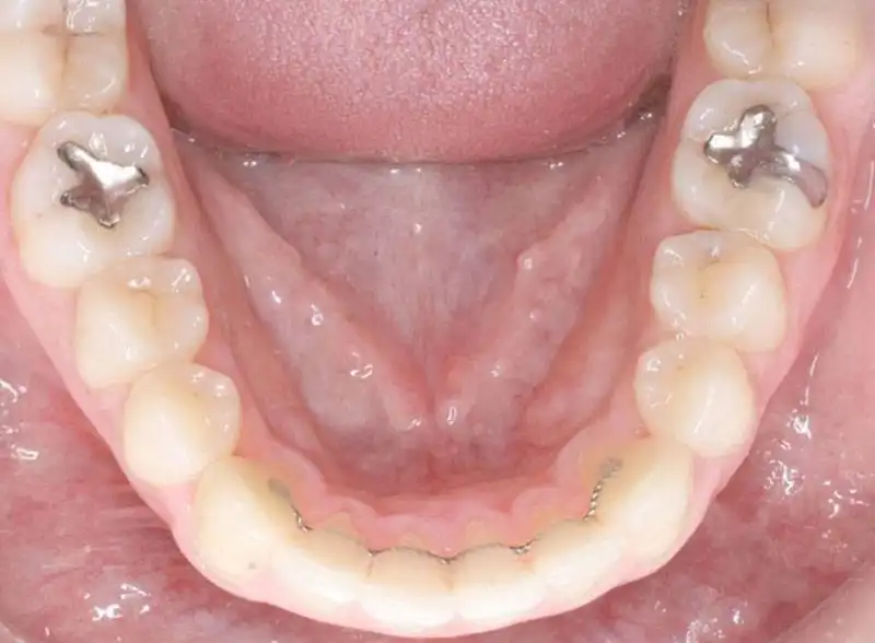 lower-orthodontic-retainer