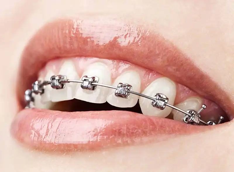 metal orthodontics marbella