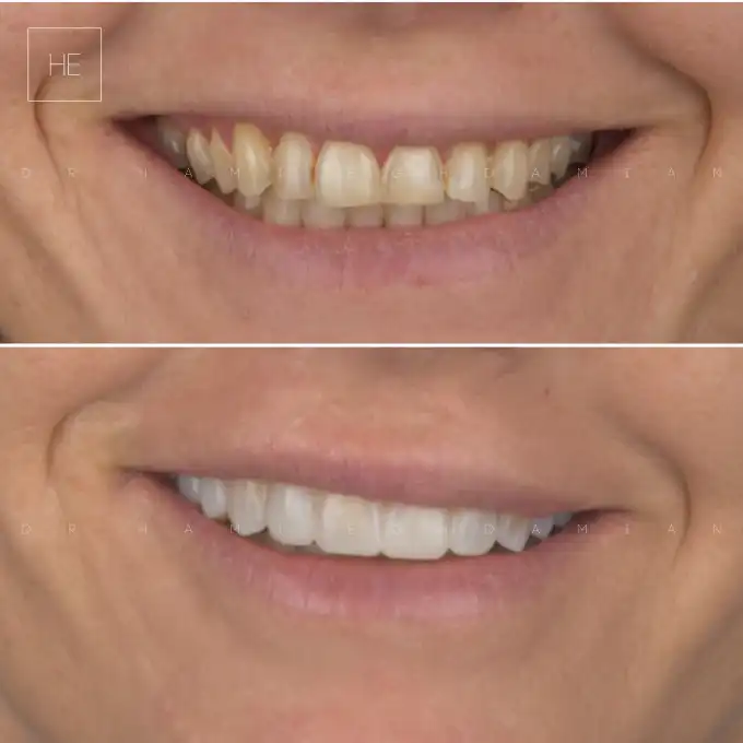 smile design in marbella