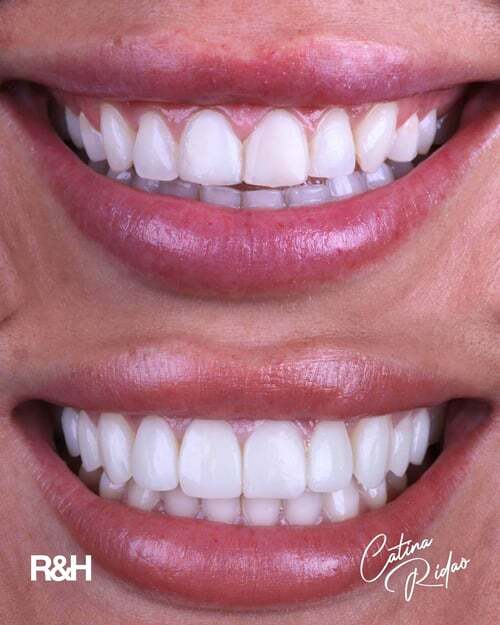no-shave-composite-veneers-marbella