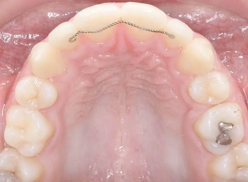 orthodontic-retainer