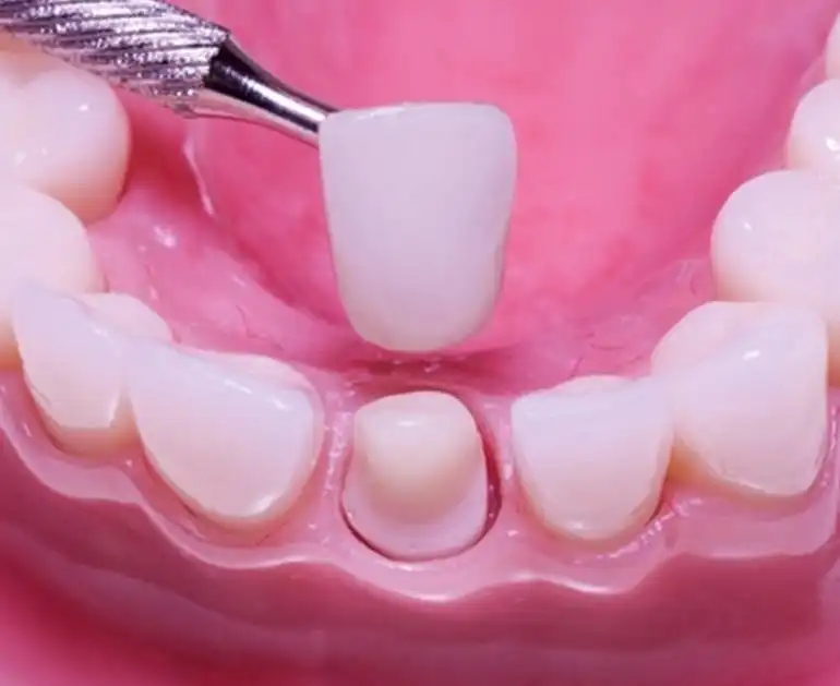 porcelain-dental-crown-prepared-tooth