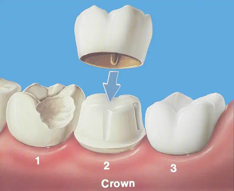 porcelain-dental-crown